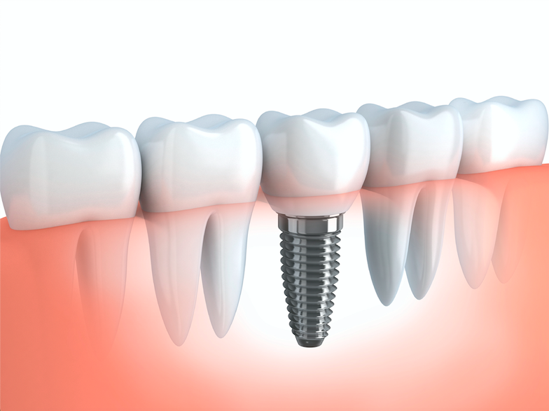 FAQs About Dental Implants in Greenbelt, MD